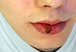 Aumento casos de sifilis